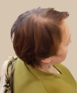 Female Pattern Hair Loss Stage II